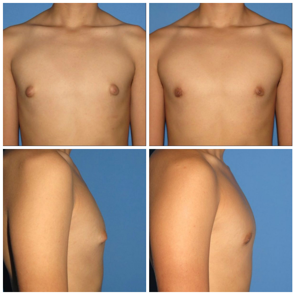 type-1 gynecomastia before after surgery
