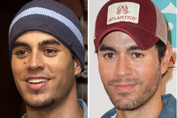 EnriqueIglesias Before & After