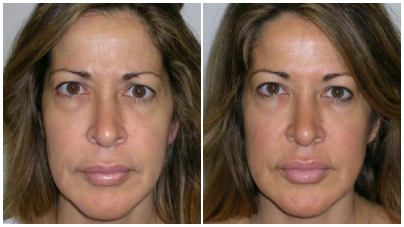 botox-before-after