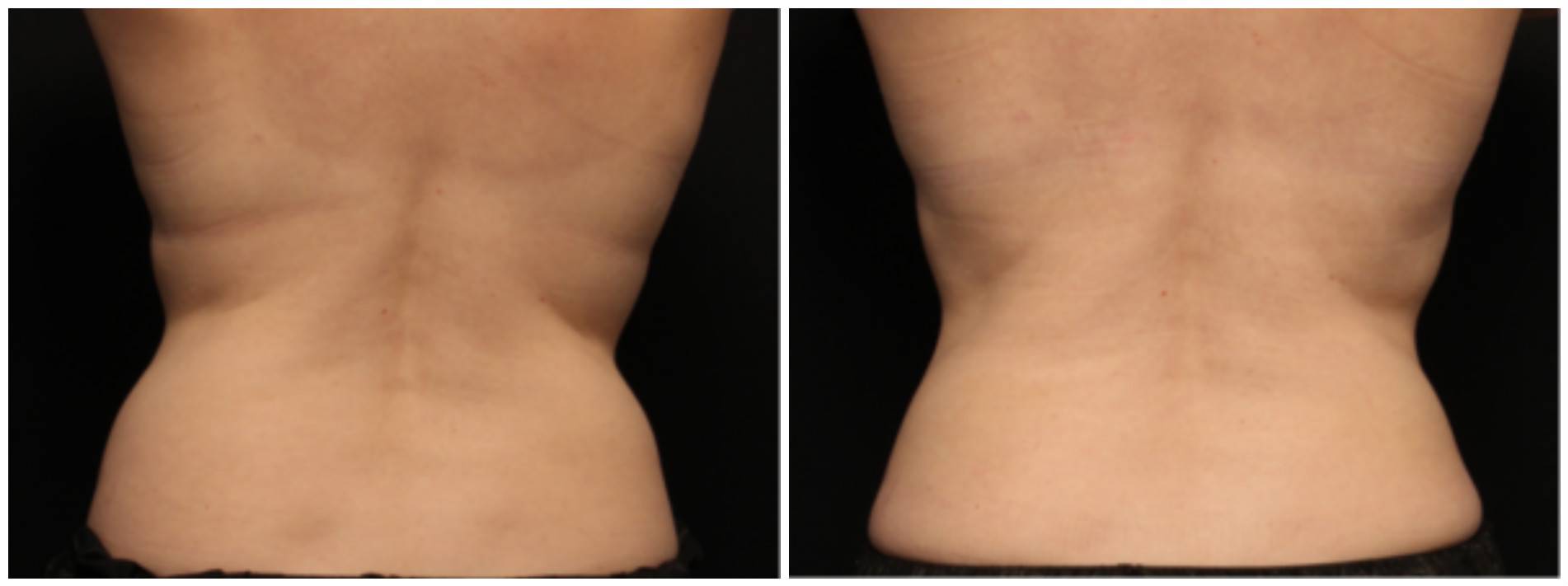 coolsculpting, before and after - back view