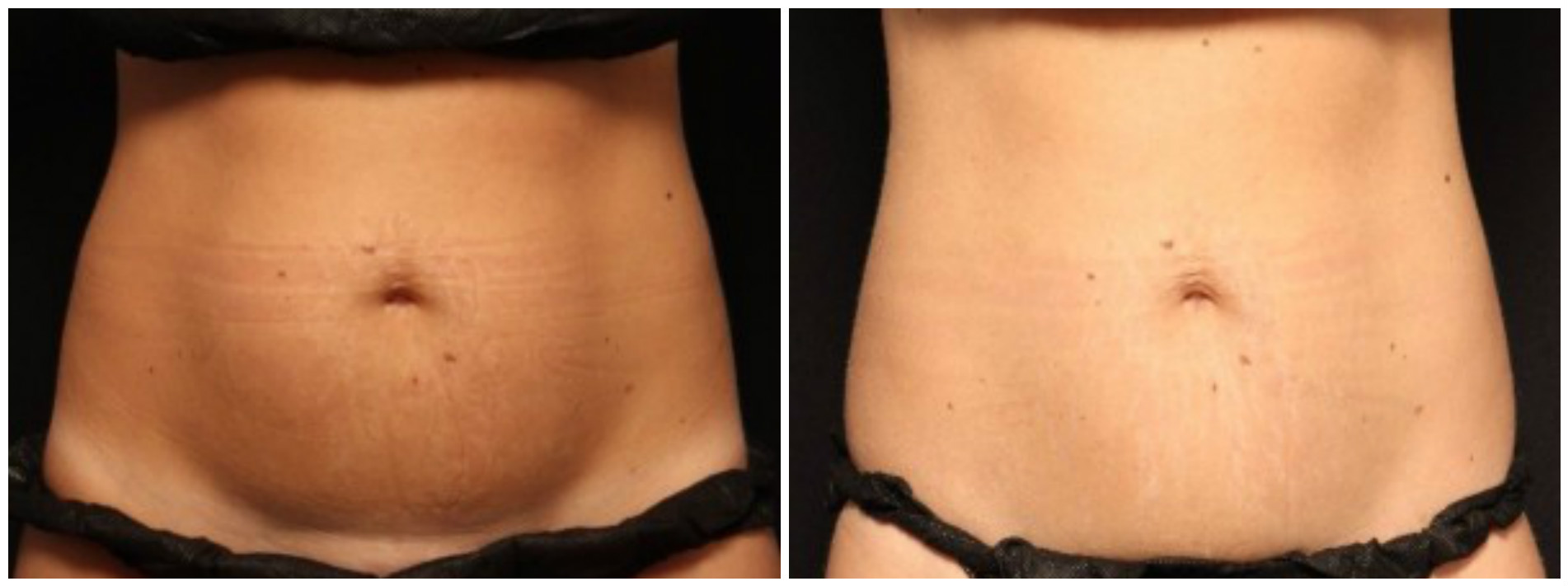https://www.zwivel.com/newsroom/wp-content/uploads/2016/06/coolsculpting, before and after - front