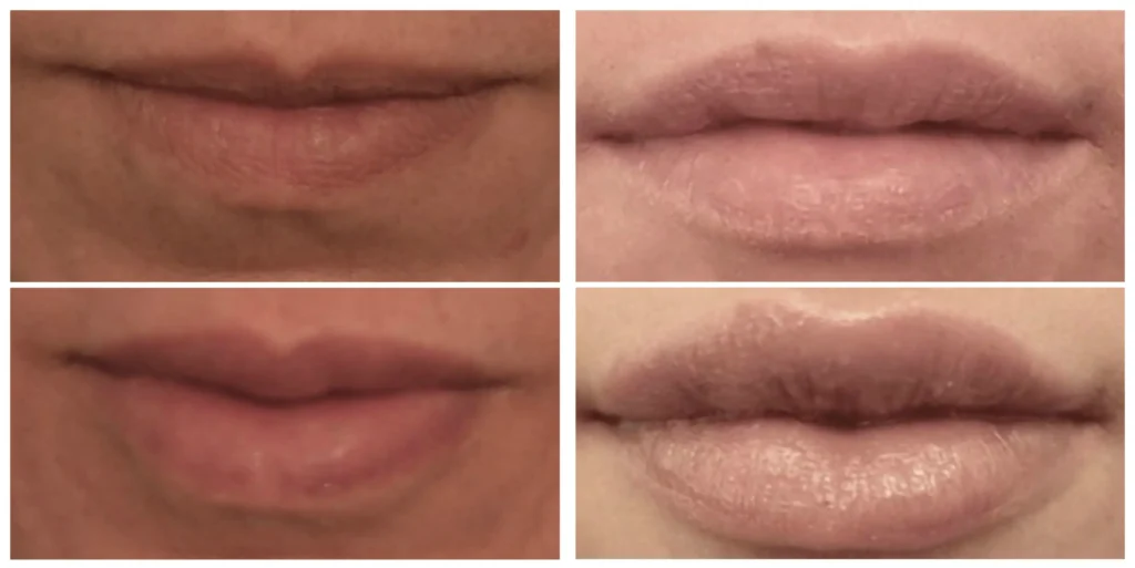 before and after resthylane silk lip injections