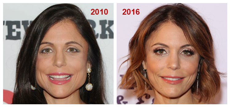Jaw Botox: The Secret to Real Housewife Bethenny Frankel’s New Look