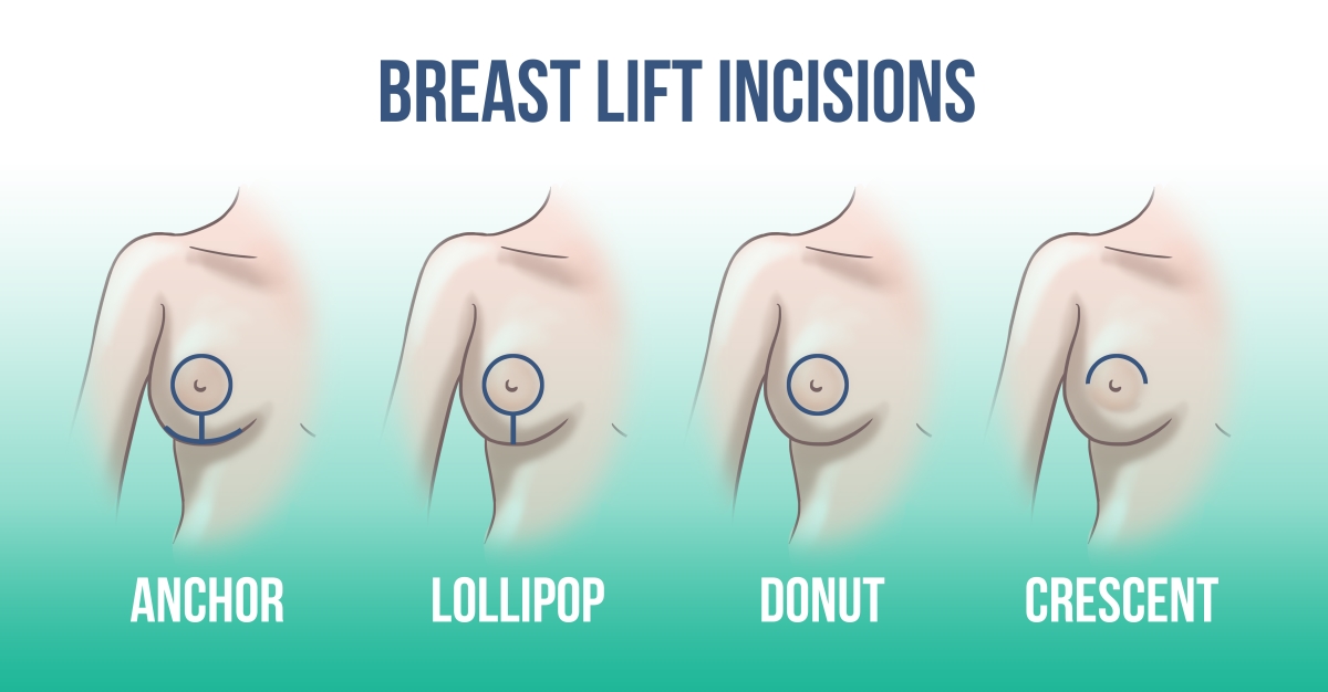 breast lift scar types