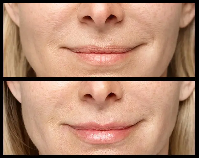 Before and after Resthylane Silk lip filler injections. Credits: Galderma 