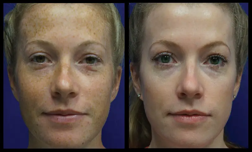 freckle treatment before after