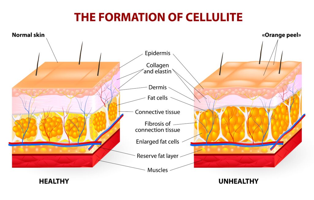 cellulite cross-section