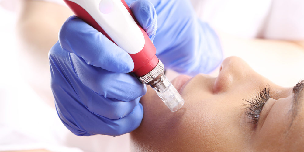 microneedling scar therapy