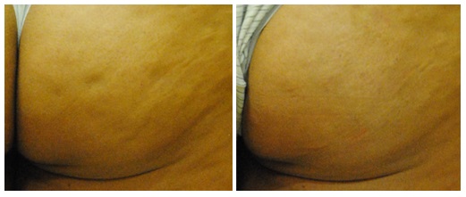 cellulite before and after cellfina