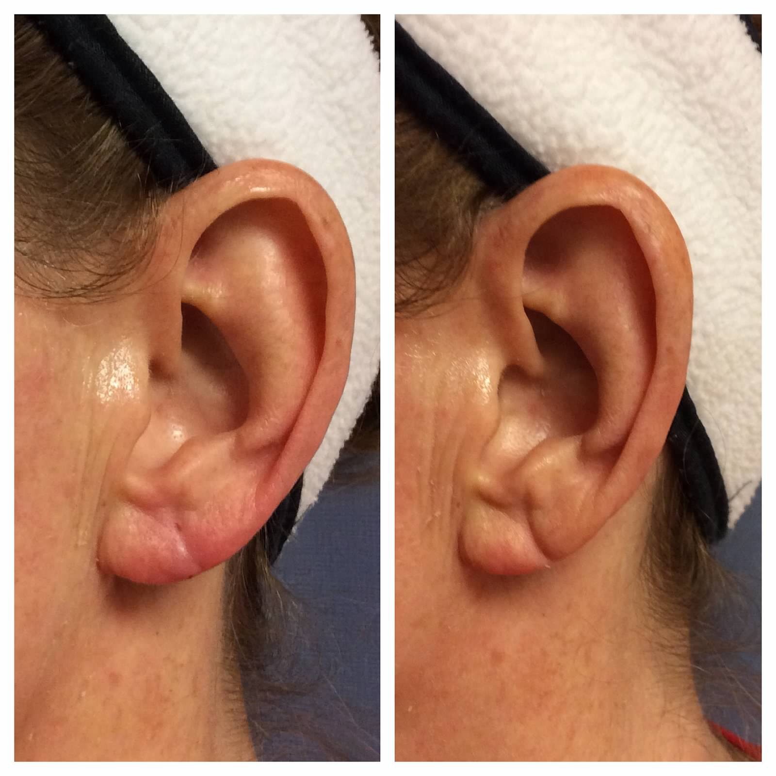 earlobe rejuvenation