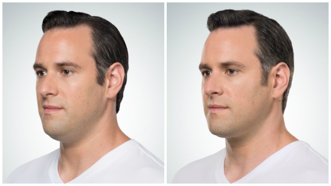 kybella, before and after