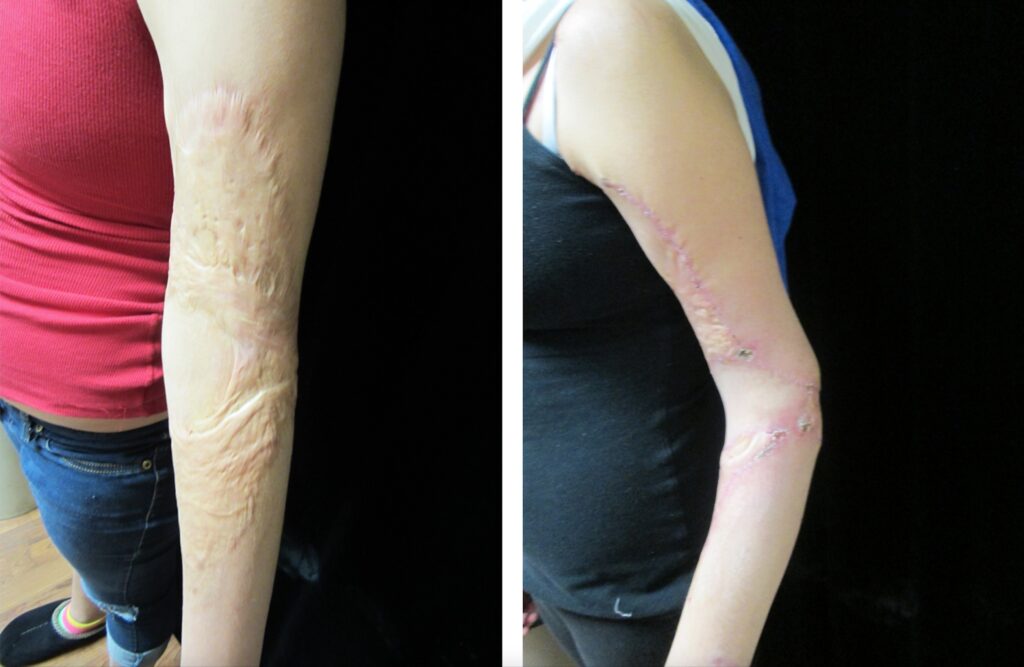 burn treatment before and after