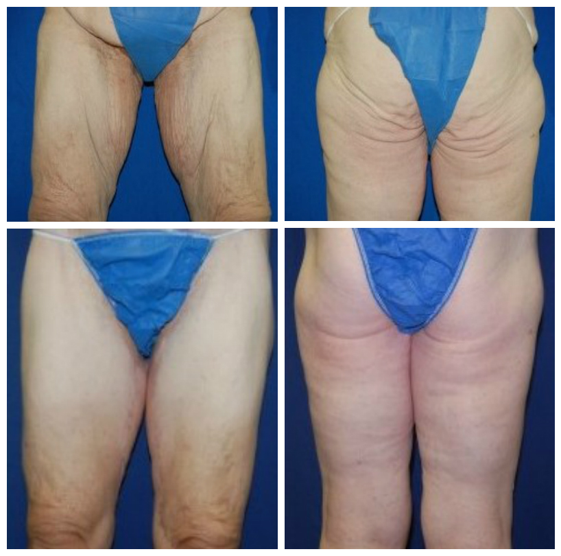 thigh lift before-after