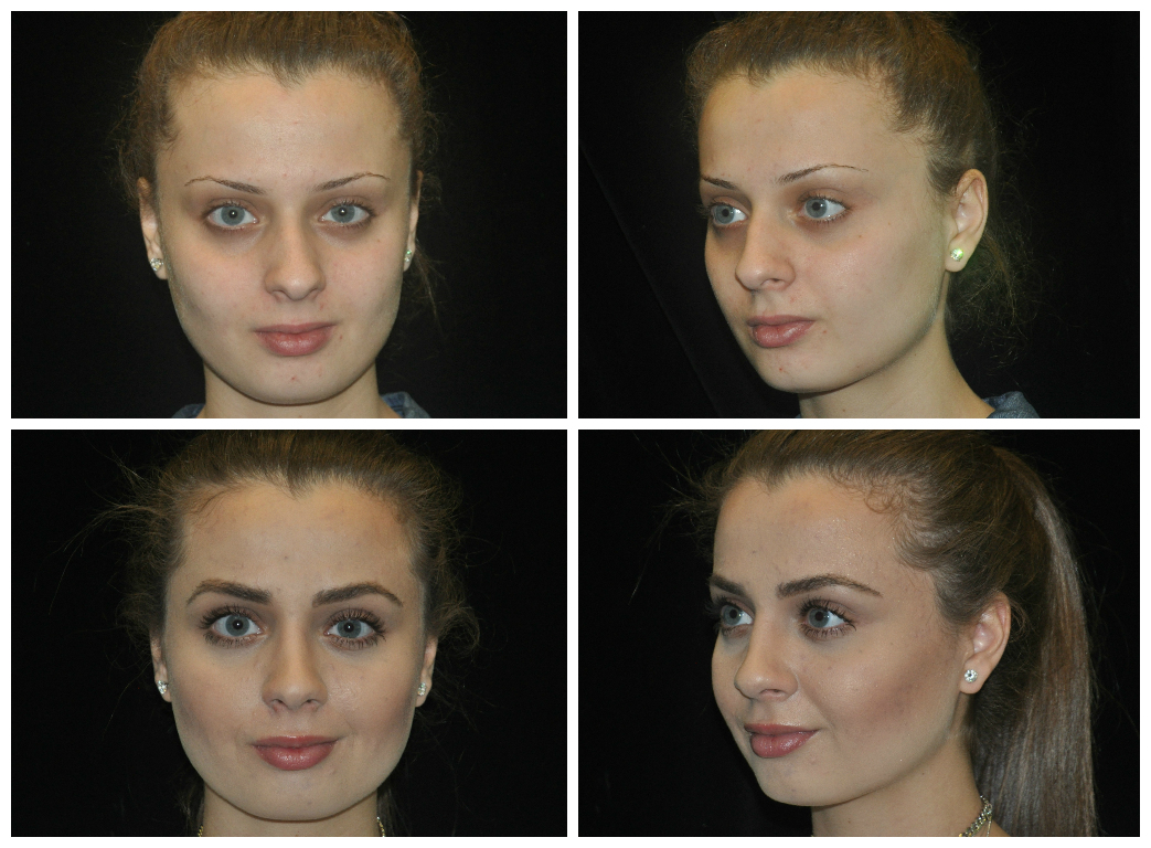 before and after eyebrow grafting