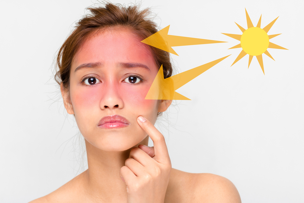 grådig ulæselig Underskrift How to Heal Sunburn Fast: Symptoms, Treatment, and Prevention