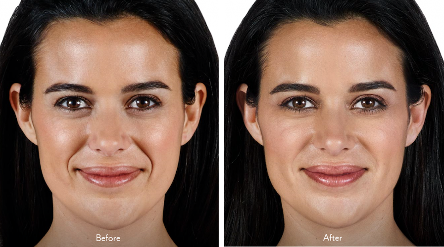 Juvederm-Vollure-Before-After