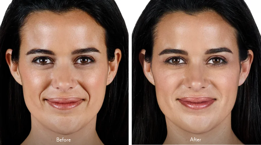 Juvederm-Vollure-Before-After