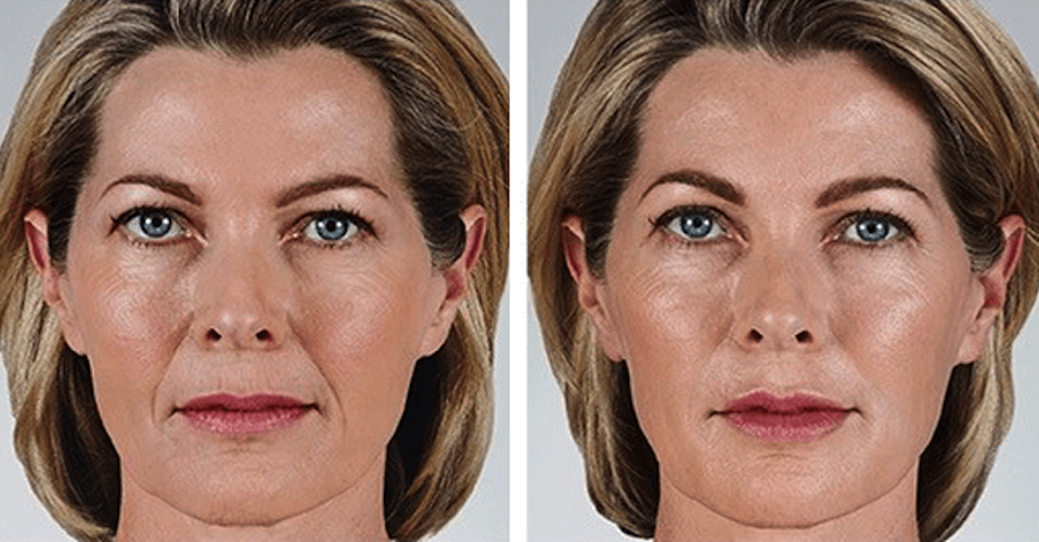 Juvederm Vollure XC Before and After