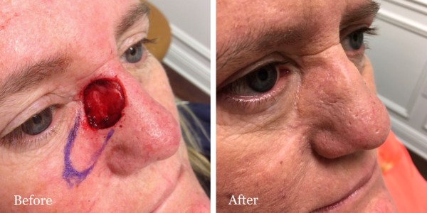 before and after mohs reconstruction nose