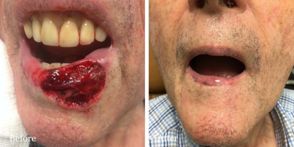 before and after mohs reconstruction lip