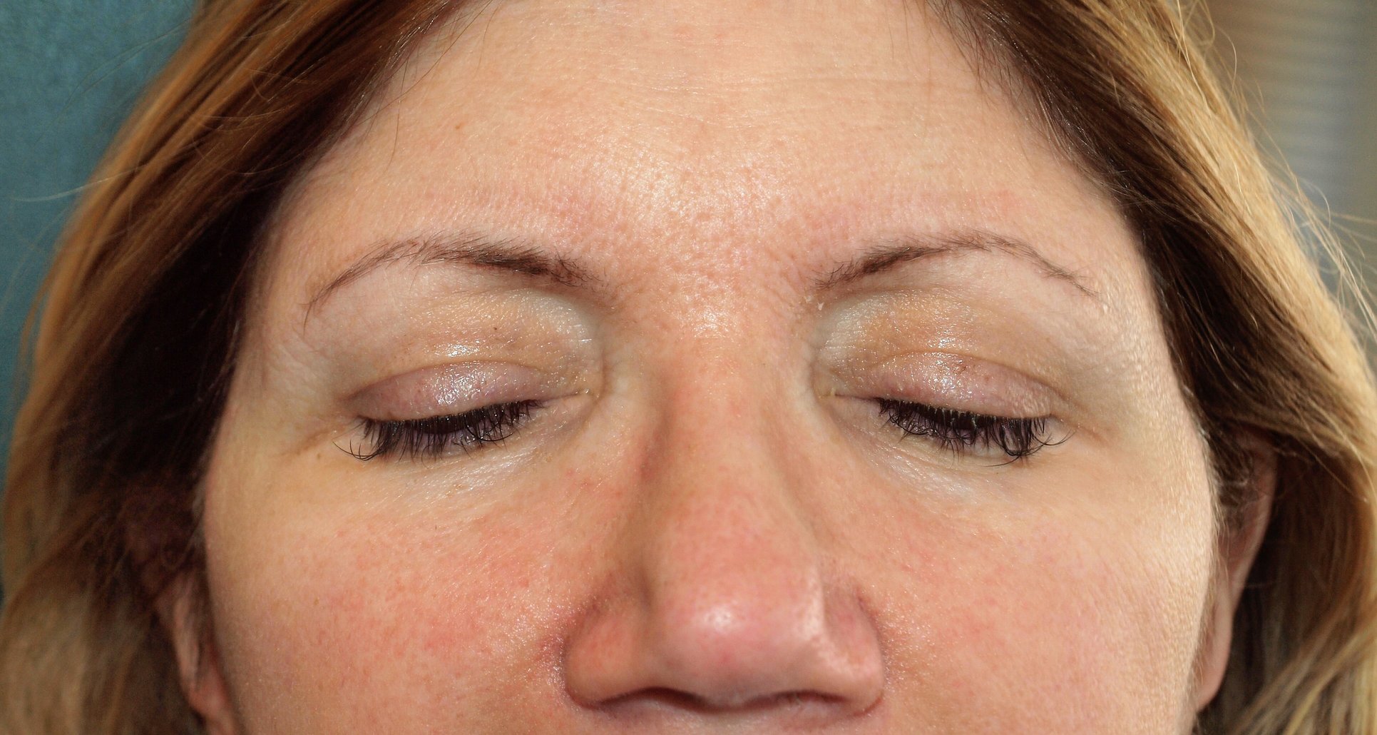 My in February, after my Sculptra treatments.
