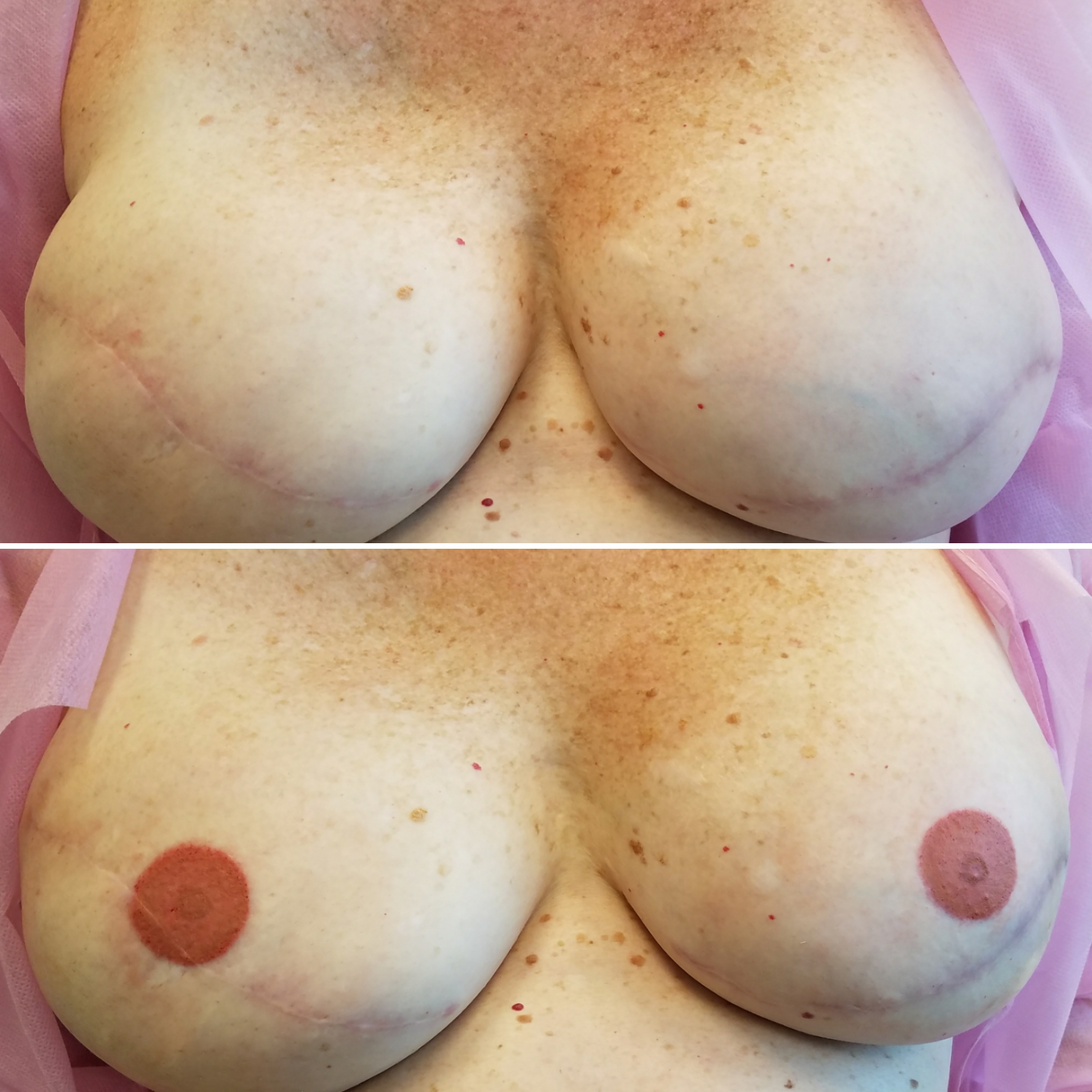 areola tattoo before and after