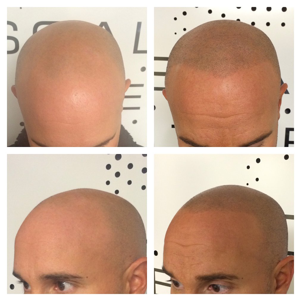 Before and after scalp micropigmentation.