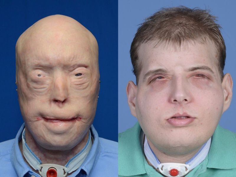 full face transplant