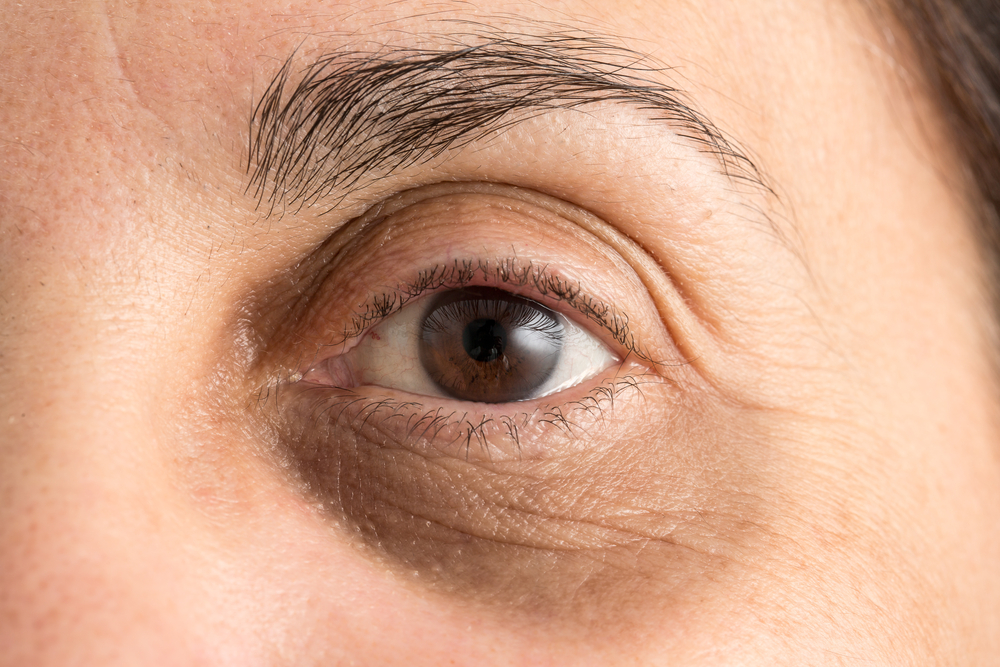 Eye Treatments - Rejuvenate Laser & Skin Clinic