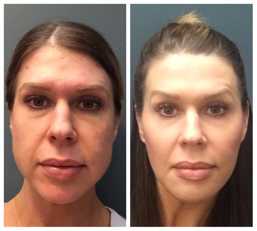 Before and after buccal fat removal