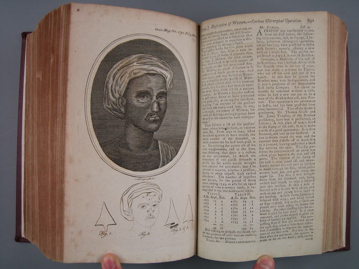 Indian method of nose reconstruction, illustrated in the Gentleman's Magazine, 1794.