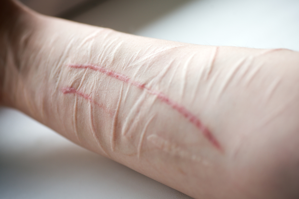 Healing Self Harm Scars