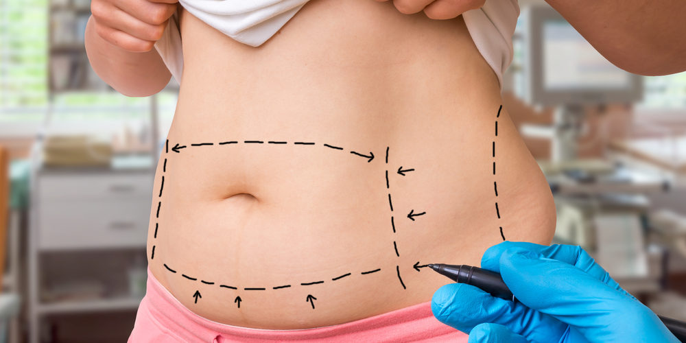 Liposuction and Recovery Results