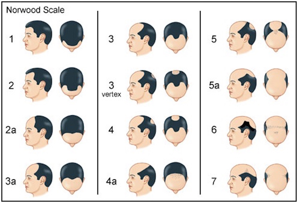Norwood Scale for hair loss