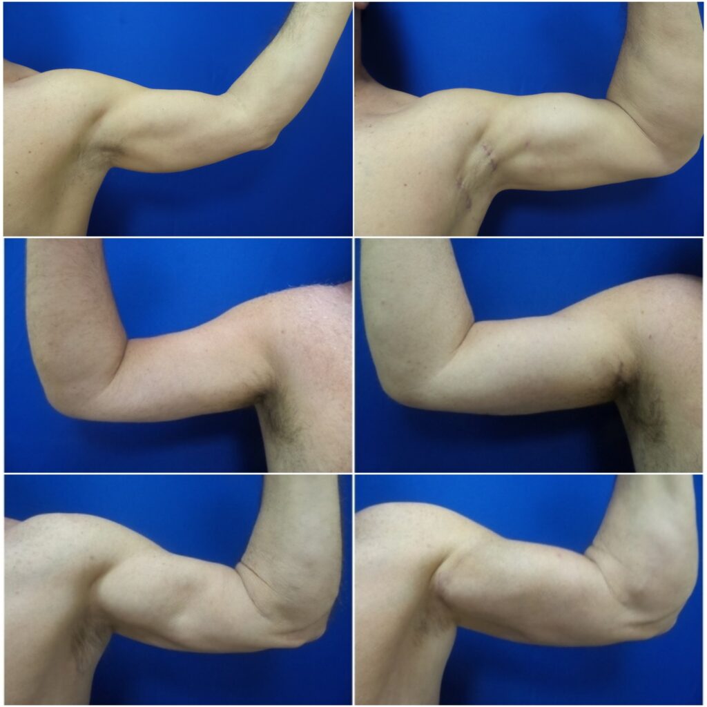 before after biceps implants