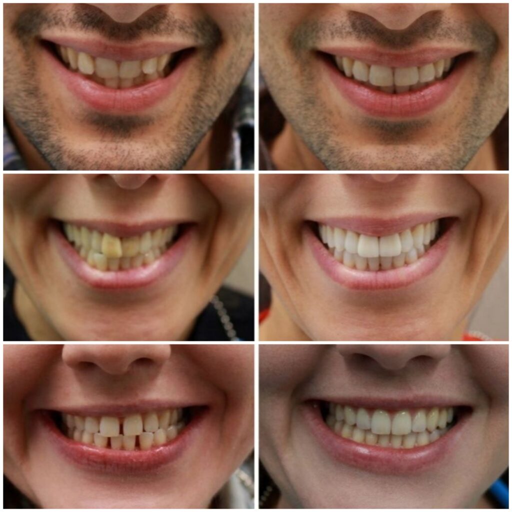 before and after invisalign