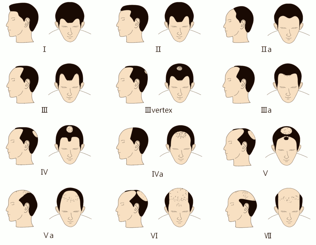 Male Pattern Baldness Understanding the Norwood Scale