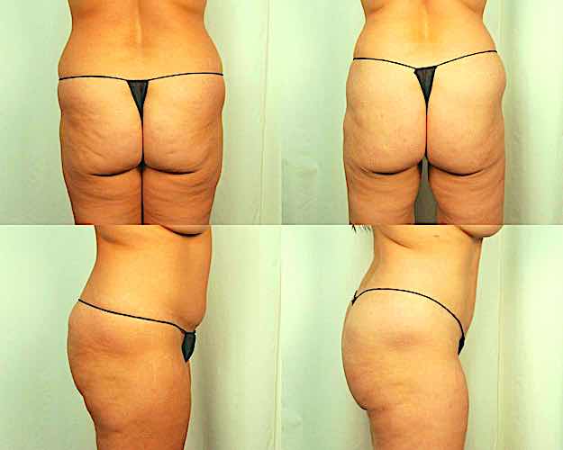 Cellulaze Before and After