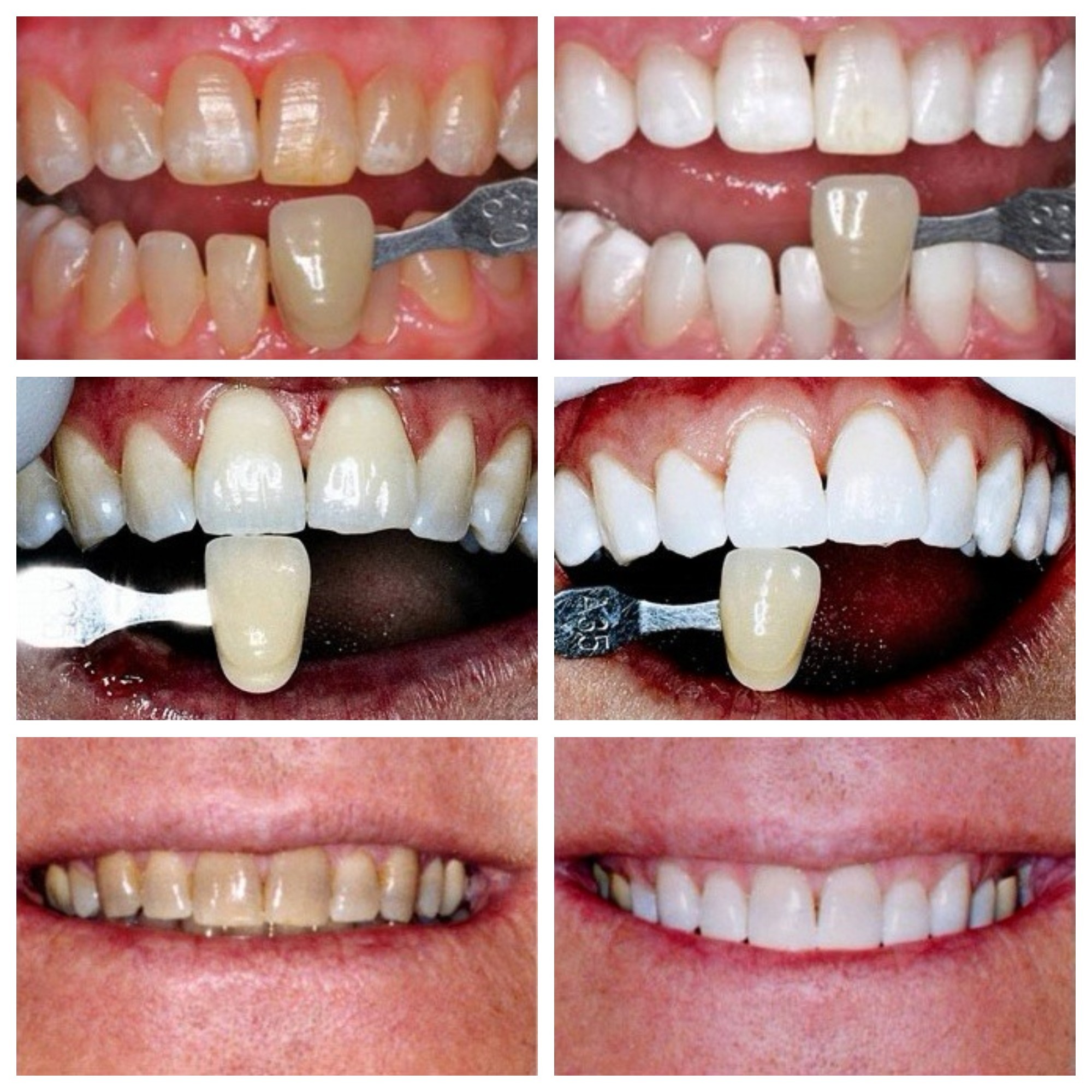KöR Whitening Before and After