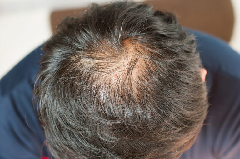 Scalp Reduction Surgery: The 'Barbaric' Hair Loss Treatment Explained