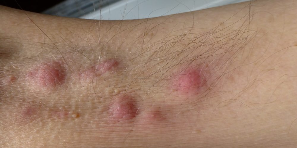 acne inversa armpit