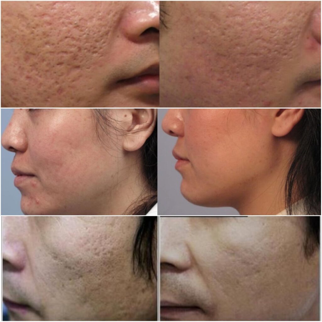 before and after laser acne