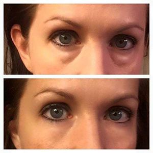 Instantly Ageless B&A