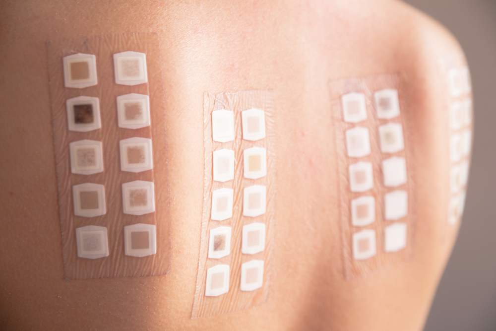 Skin Tests for allergies