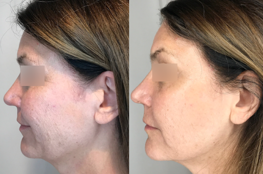 Cryotherapy B&A