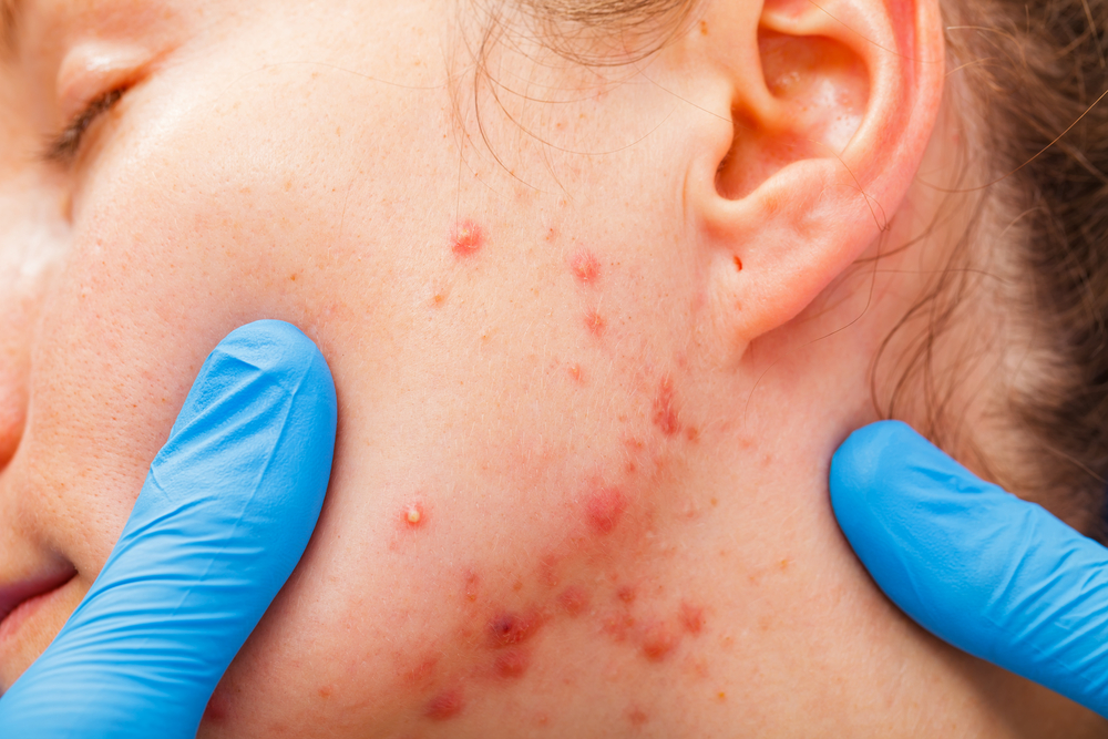 Treating cystic acne