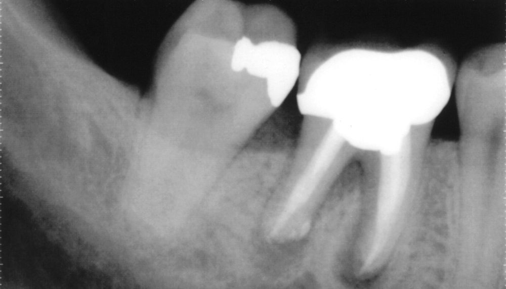 Failed Root Canal with infection in the gum between the roots, due to a crack in the Molar