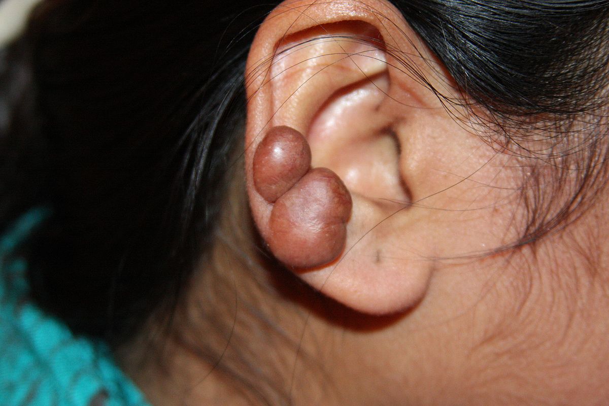 Severe keloid growth on the ear