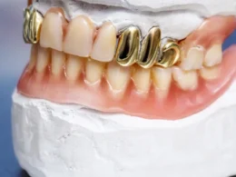 gold tooth implant
