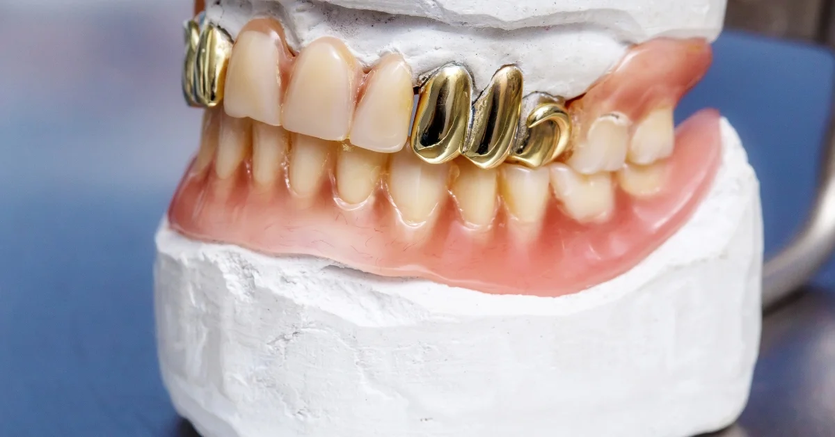 What's A Smile Worth? The Pros and Cons of Gold Teeth Implants